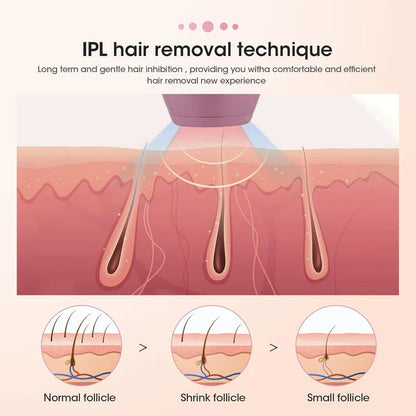 Illustration of IPL hair removal technique with hair follicle stages.